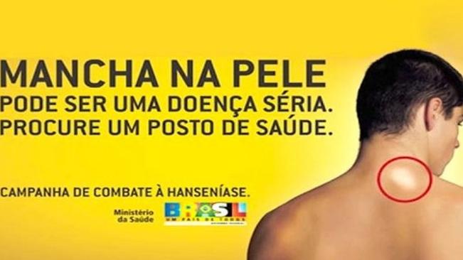 UsuÃ¡rios das UBS recebem orientaÃ§Ãµes sobre a HansenÃ­ase